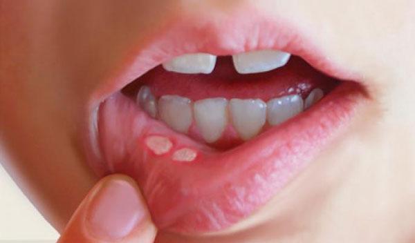 Cần làm gì khi gặp tình trạng viêm loét miệng ở trẻ em?