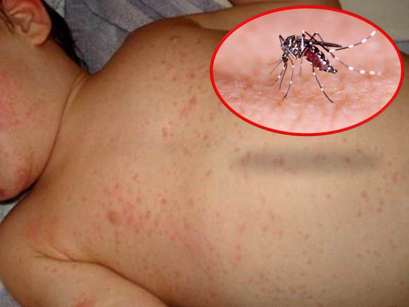 Trẻ bị sốt về đêm có thể là dấu hiệu cảnh báo bệnh sốt xuất huyết