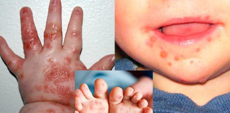 Bệnh tay chân miệng thường xảy ra ở trẻ nhỏ vào mùa hè