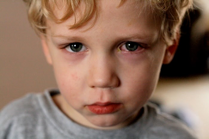 Tìm hiểu về bệnh đau mắt đỏ ở trẻ em